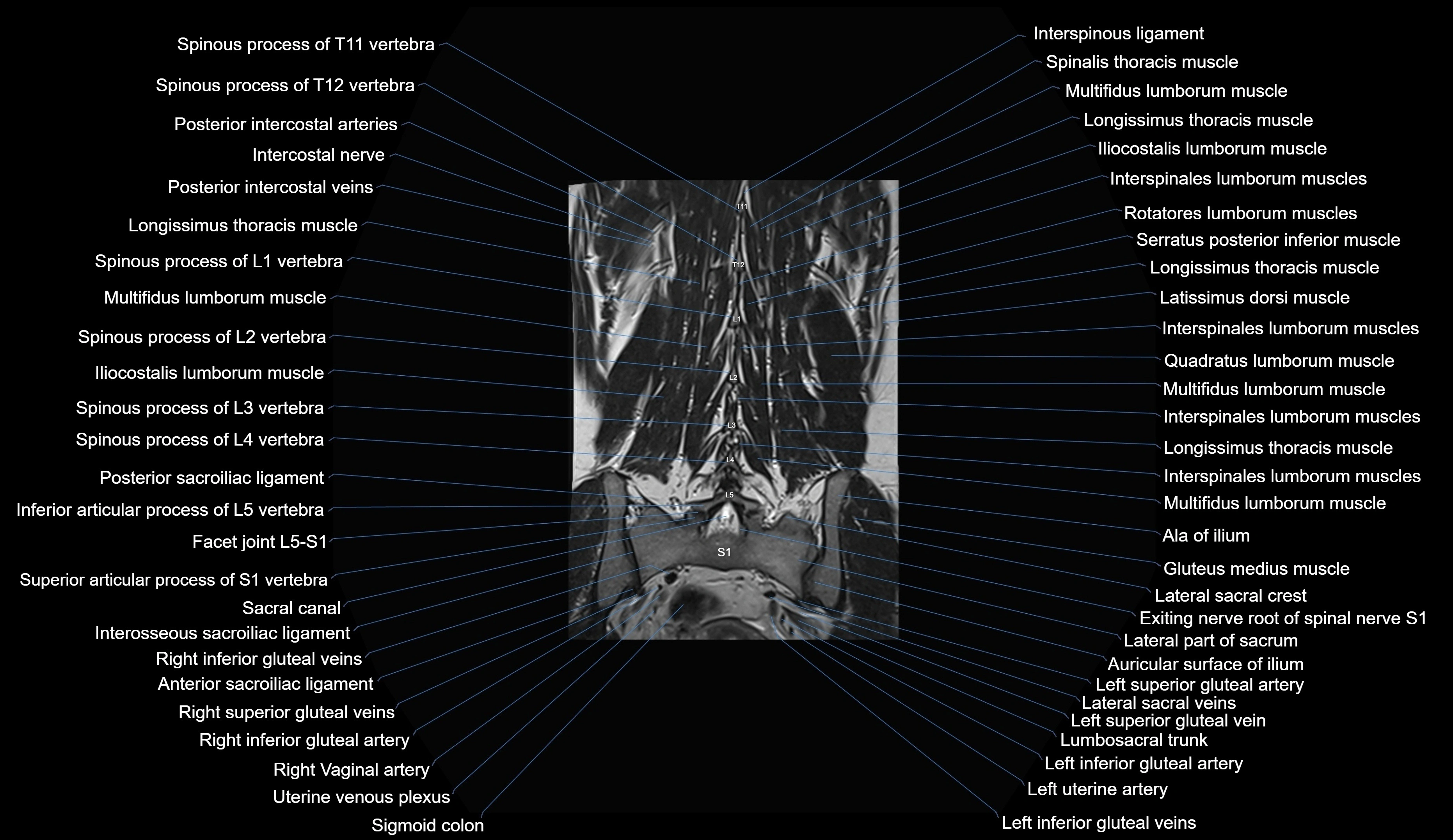 MRI lumbar spine coronal cross sectional anatomy 3T radiology  image-img-00001-00026.webp